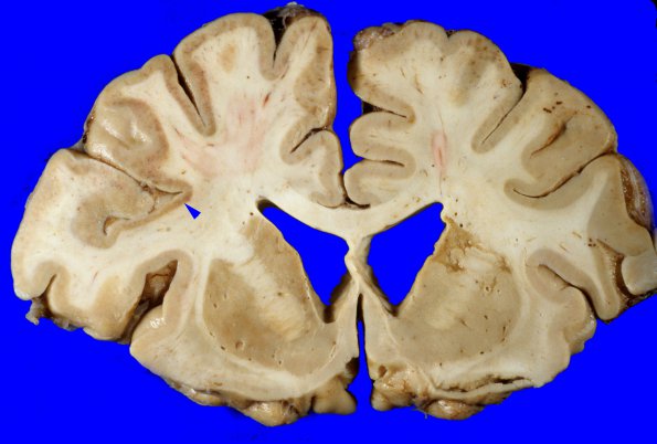 1A4 Hypoxia-Ischemia, Laminar Necrosis (Case 1) 2 copy