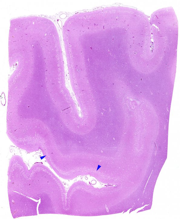 1B2 Hypoxia-Ischemia, Laminar Necrosis (Case 1) H&E WM