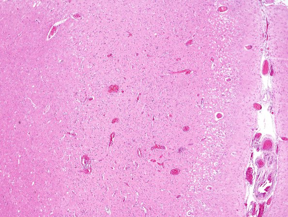 1B3 Hypoxia-Ischemia, Laminar Necrosis (Case 1) H&E 1B