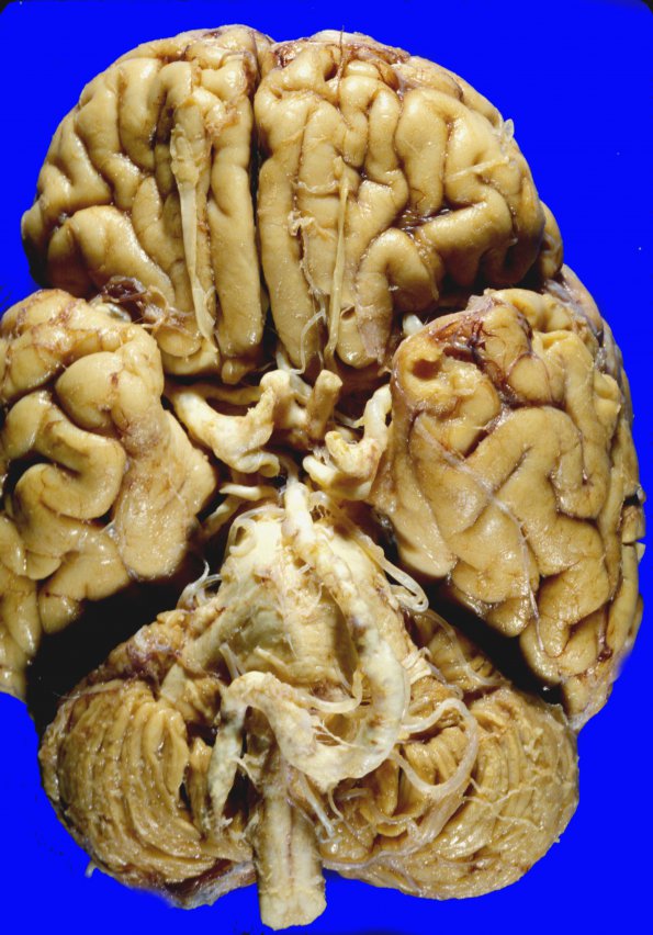 2 Atherosclerosis (WUMS Case) 1 carotid