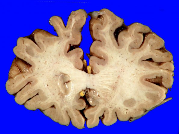 20A1 Dementia (Case 20) Gross_6