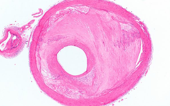 20B2 Dementia (Case 20) H&E 4X