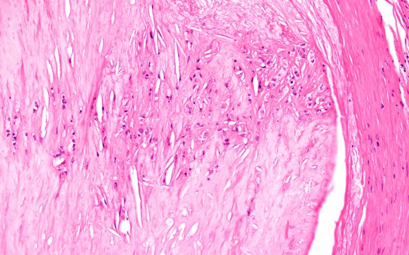 20B3 Dementia (Case 20) H&E 40X 2