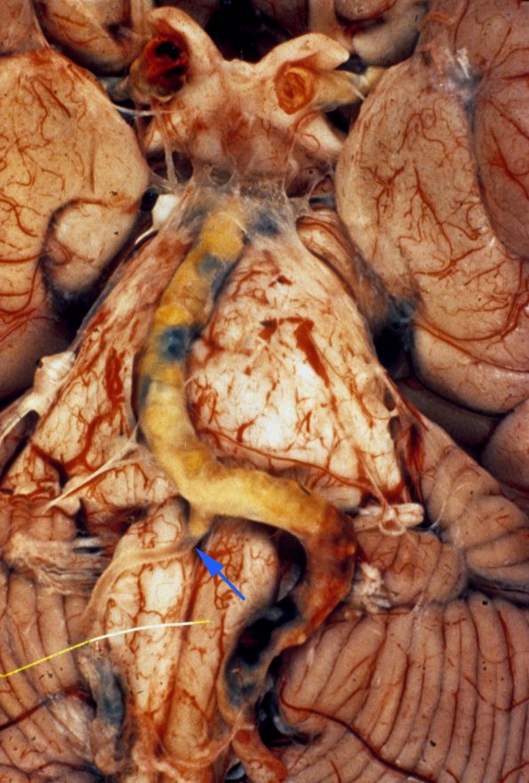 3 Atherosclerosis (may not be WUMS) copy