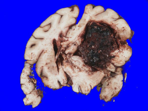 5A1 Atherosclerosis, small vessel (Case 5) _1