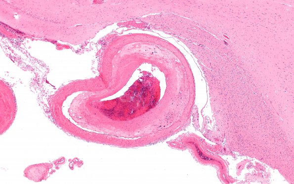 5B2 Atherosclerosis (Case 5) N3 4X 2