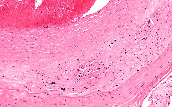 5B3 Atherosclerosis (Case 5) N3 20X 1