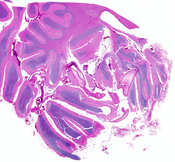 5C1 Atherosclerosis, small vessel (Case 5) H&E 2