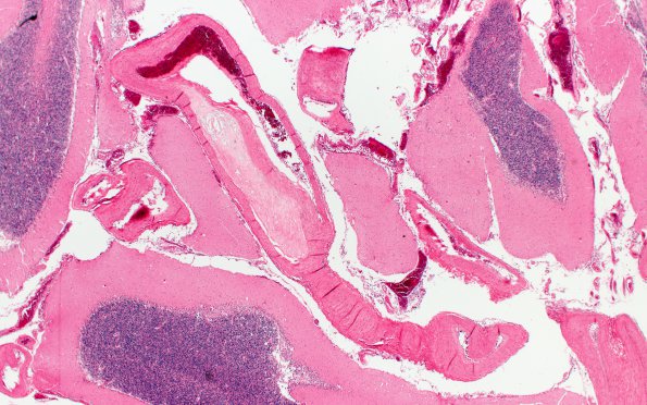 5C4 Atherosclerosis (Case 5) 2X