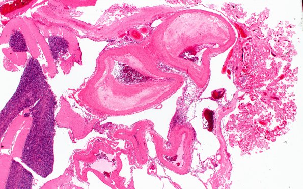 5C6 Atherosclerosis (Case 5) N15 2X 1