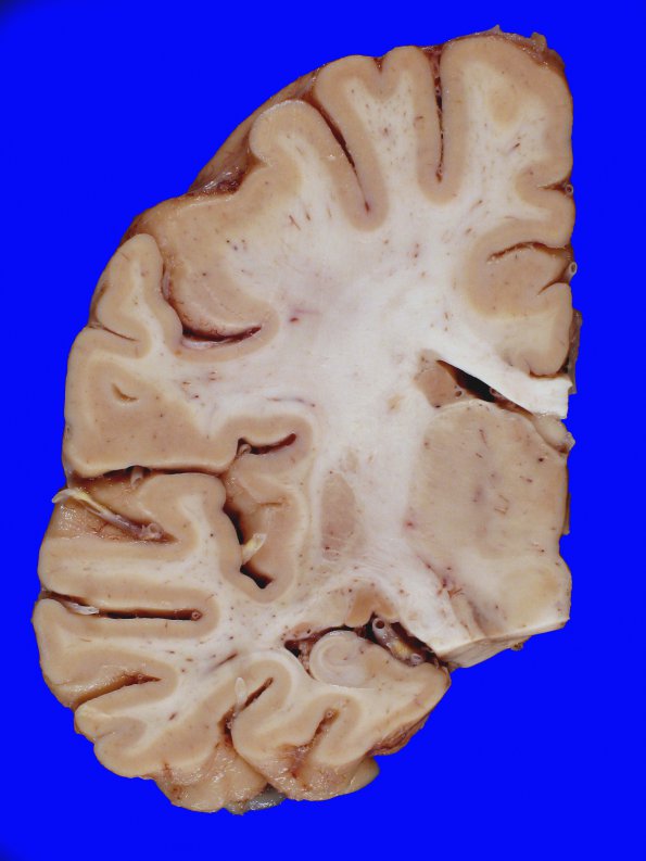 6A1 Atherosclerosis (Case 6) gross 1