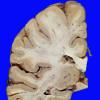 6A3 Atherosclerosis (Case 6) gross 5