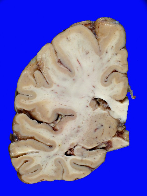 6A3 Atherosclerosis (Case 6) gross 5