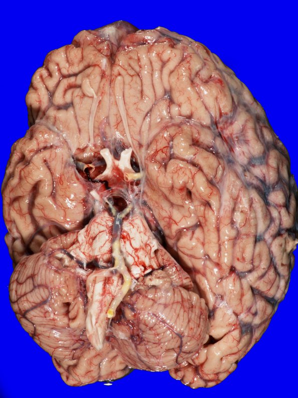 7A1 Atherosclerosis (Case 7)_1