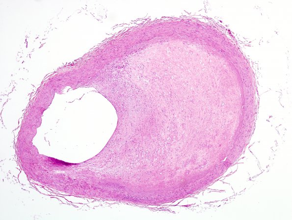 7B1 Atherosclerosis (Case 7) H&E 3