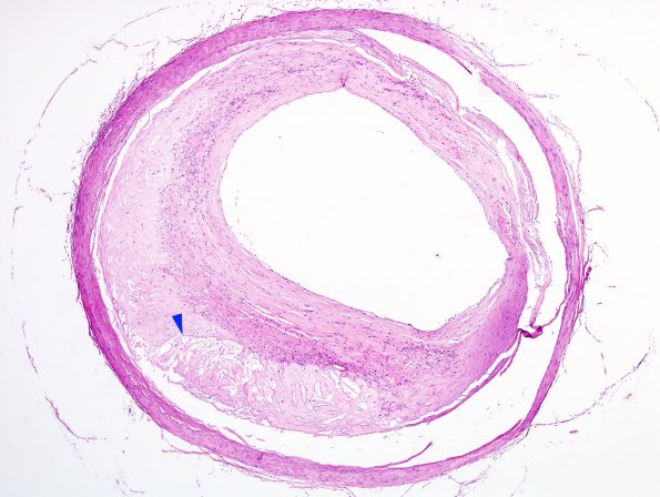 7B2 Atherosclerosis (Case 7) H&E 1 copy