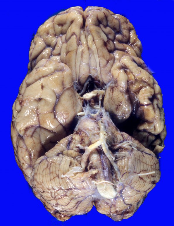 9A1 Infarcts, multiple, severe atherosclerosis (Case 9) 5