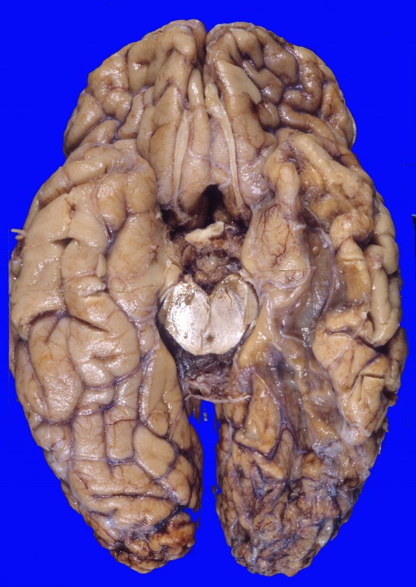 9A2 Infarcts, multiple, severe atherosclerosis (Case 9) 1