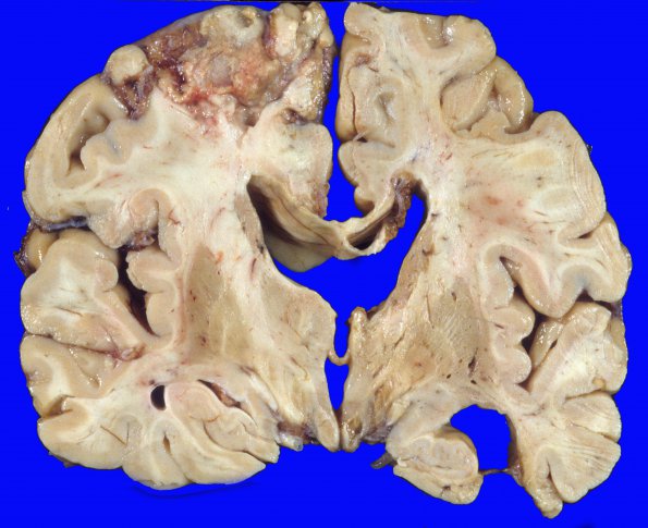 9A3 Infarcts, multiple, severe atherosclerosis (Case 9) 2