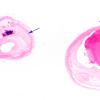 9B1 Infarcts, multiple, severe atherosclerosis (Case 9) 2X copy