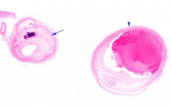 9B1 Infarcts, multiple, severe atherosclerosis (Case 9) 2X copy