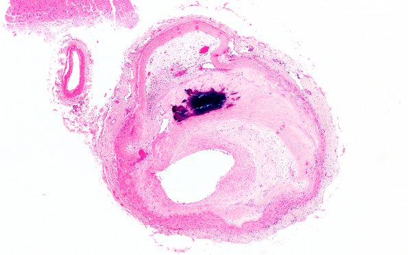 9B2 Infarcts, multiple, severe atherosclerosis (Case 9) 4X