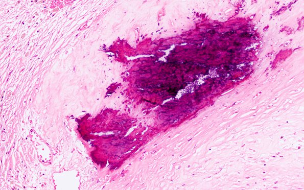 9B3 Infarcts, multiple, severe atherosclerosis (Case 9) 20X 3