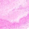 9B4 Infarcts, multiple, severe atherosclerosis (Case 9) 20X 2