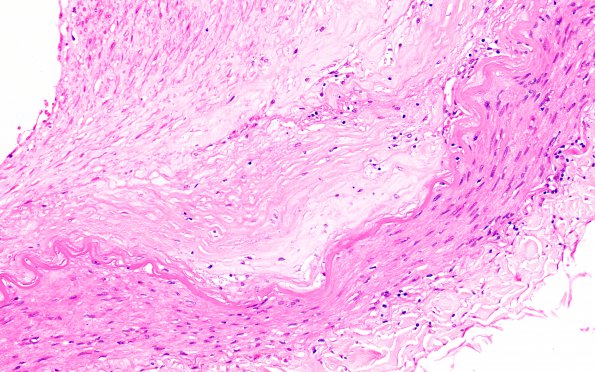 9B4 Infarcts, multiple, severe atherosclerosis (Case 9) 20X 2