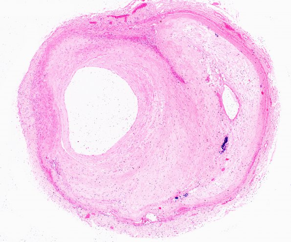 9B5 Infarcts, multiple, severe atherosclerosis (Case 9) 4X 3