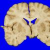 1A1 Hypotensive Brainstem Necrosis (Case 1) Gross_1