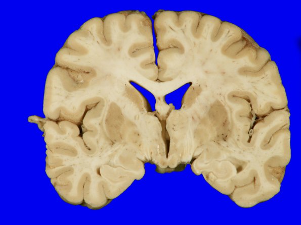 1A1 Hypotensive Brainstem Necrosis (Case 1) Gross_1