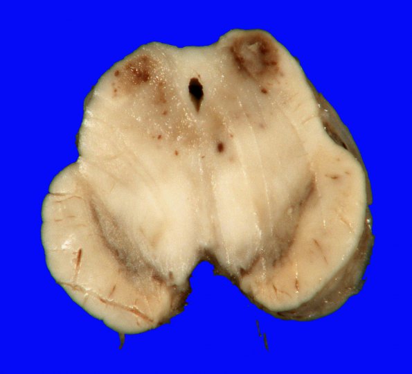 1A2 Hypotensive Brainstem Necrosis (Case 1) Gross_2