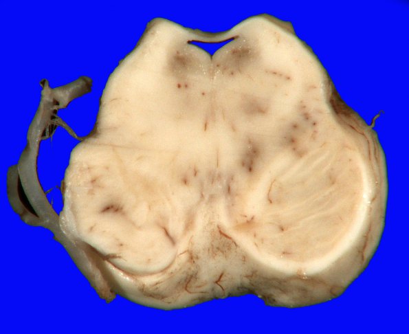 1A3 Hypotensive Brainstem Necrosis (Case 1) Gross_3