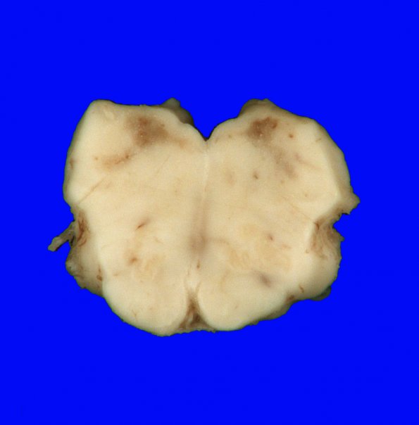 1A4 Hypotensive Brainstem Necrosis (Case 1) Gross_7