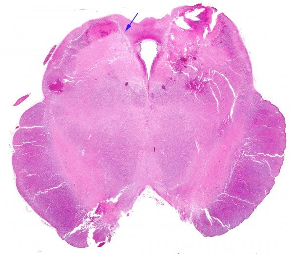 1B1 Hypotensive Brainstem Necrosis (Case 1) H&E N6 Midbrain WM copy