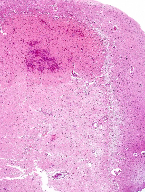 1B2 Hypotensive Brainstem Necrosis (Case 1) H&E N6 Midbrain 1