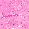 1B3 Hypotensive Brainstem Necrosis (Case 1) H&E N6 Midbrain 1