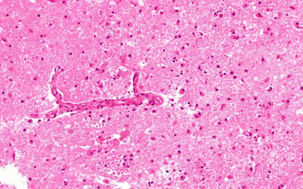 1B3 Hypotensive Brainstem Necrosis (Case 1) H&E N6 Midbrain 1