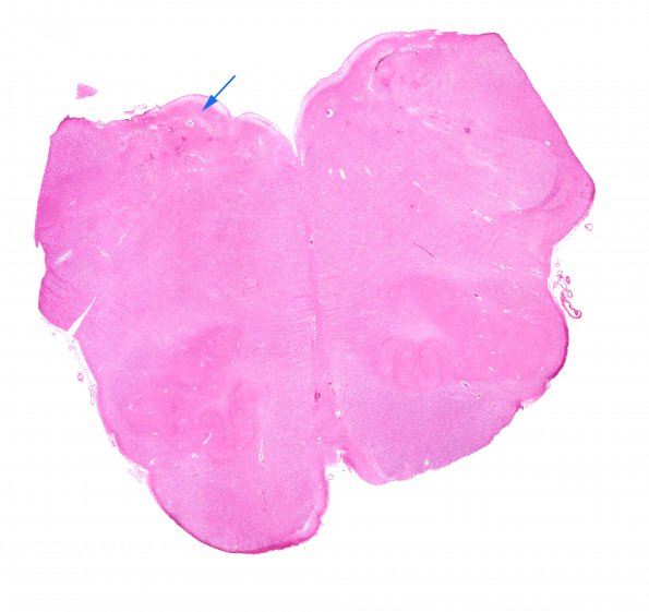 1C1 Hypotensive Brainstem Necrosis (Case 1) H&E N8 medulla 19 copy