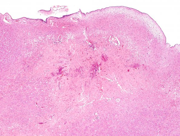 1C2 Hypotensive Brainstem Necrosis (Case 1) H&E N8 medulla 19