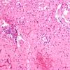 1C3 Hypotensive Brainstem Necrosis (Case 1) H&E N8 medulla 20