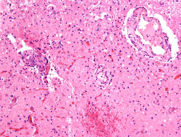 1C3 Hypotensive Brainstem Necrosis (Case 1) H&E N8 medulla 20