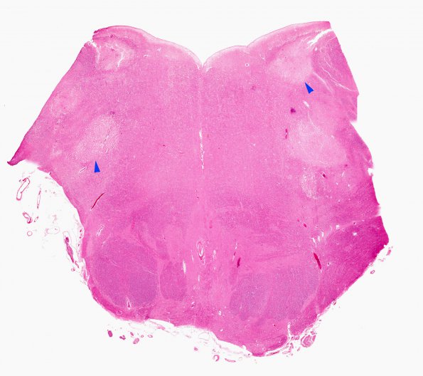 1C4 Hypotensive Brainstem Necrosis (Case 1) H&E N15 Medulla WM copy