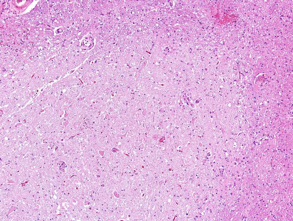 1C5 Hypotensive Brainstem Necrosis (Case 1) H&E N15 Medulla 7