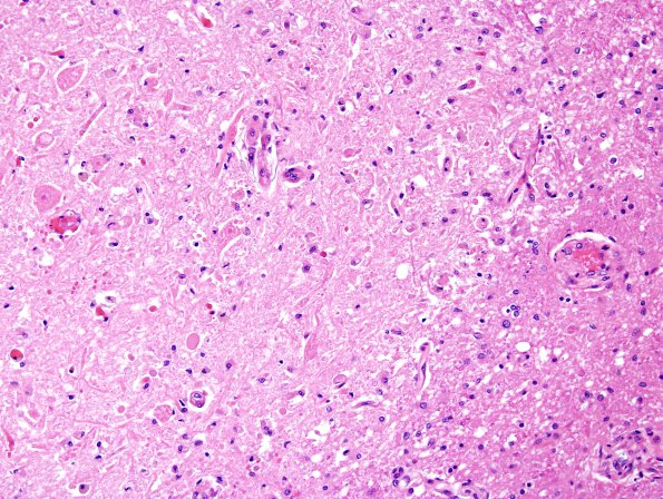 1C6 Hypotensive Brainstem Necrosis (Case 1) H&E N15 Medulla 8