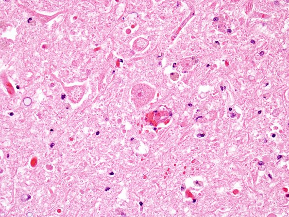 1C7 Hypotensive Brainstem Necrosis (Case 1) H&E N15 Medulla 16