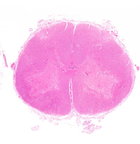 1D1 Hypotensive Brainstem Necrosis (Case 1) H&E N10 WM