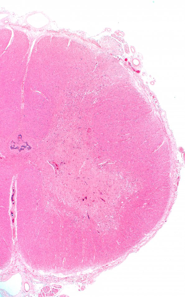 1D2 Hypotensive Brainstem Necrosis (Case 1) N10 H&E 2X