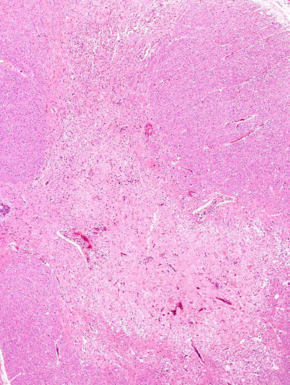 1D3 Hypotensive Brainstem Necrosis (Case 1) H&E N10 SCord 17